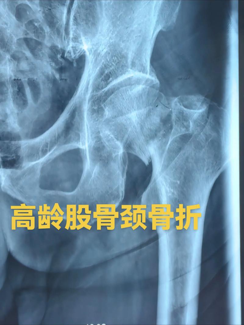 股骨骨折